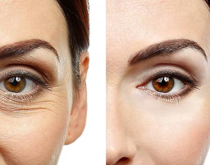 Blepharoplasty_Before_And_After_LMA_Clinic