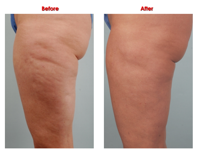 Cellulite before and after