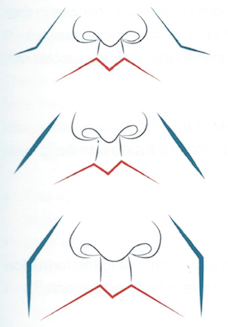 Nasolabial_Fold_Dermal_Filler