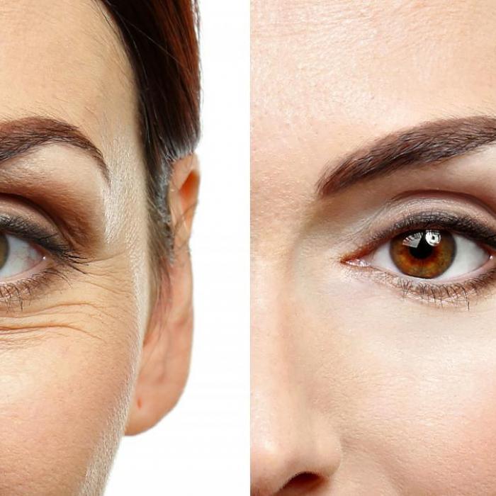 blepharoplasty 