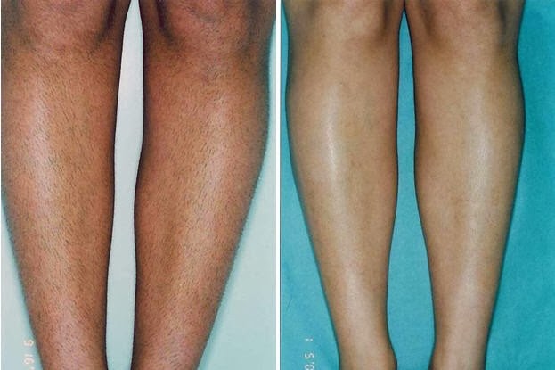 Laser Hair Removal-Dr Ayham Al-Ayoubi