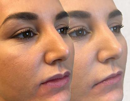 Lips Enhancement