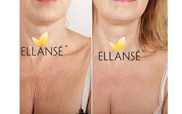 Ellanse