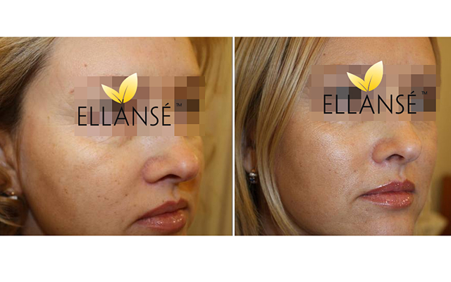 Ellanse