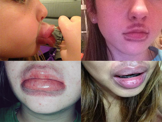 kylie lip challenge lip fillers