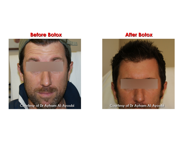 Anti-Wrinkle Injections Before & After Photos - Harley Street London