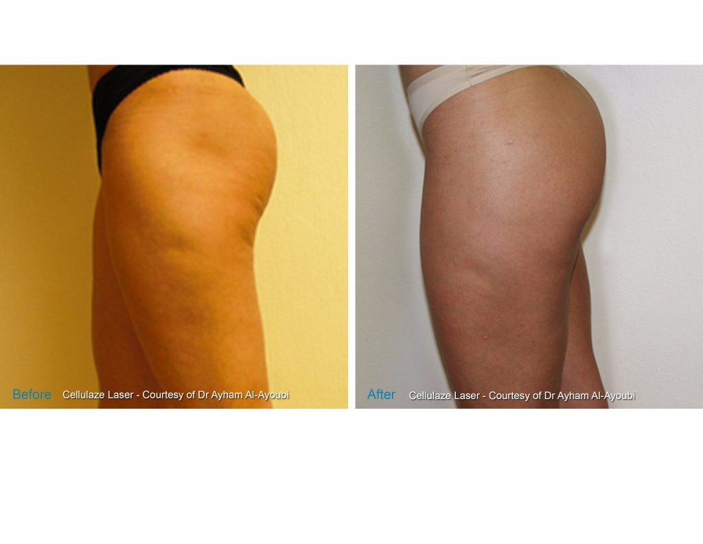 Cellulaze Laser for Permanent Cellulite Reduction by Dr Ayham Al-Ayoubi