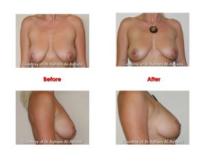 Lanluma Buttock & Hip Dips By Dr Ayham Al-Ayoubi