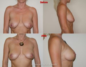 Smartlipo Scar Free Laser Breast Lift by Dr Ayoubi