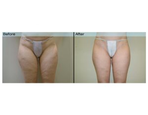 Velashape 3 - Reduce Cellulite Quick (Best Clinic in London)