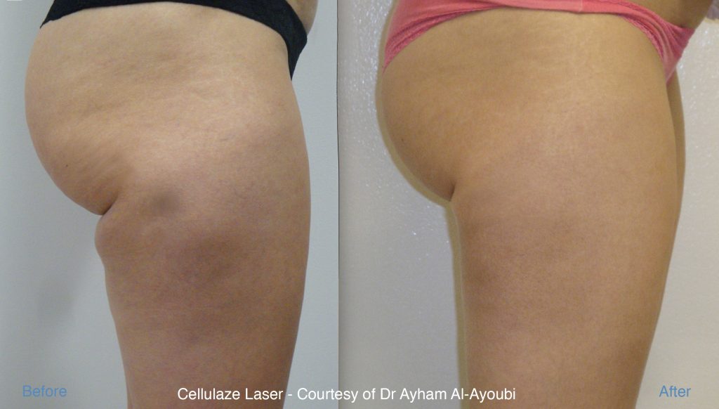 Cellulaze Laser for Permanent Cellulite Reduction by Dr Ayham Al-Ayoubi