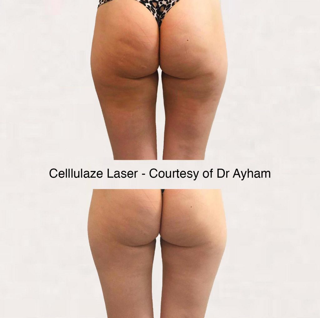 Cellulaze Laser for Permanent Cellulite Reduction by Dr Ayham Al-Ayoubi