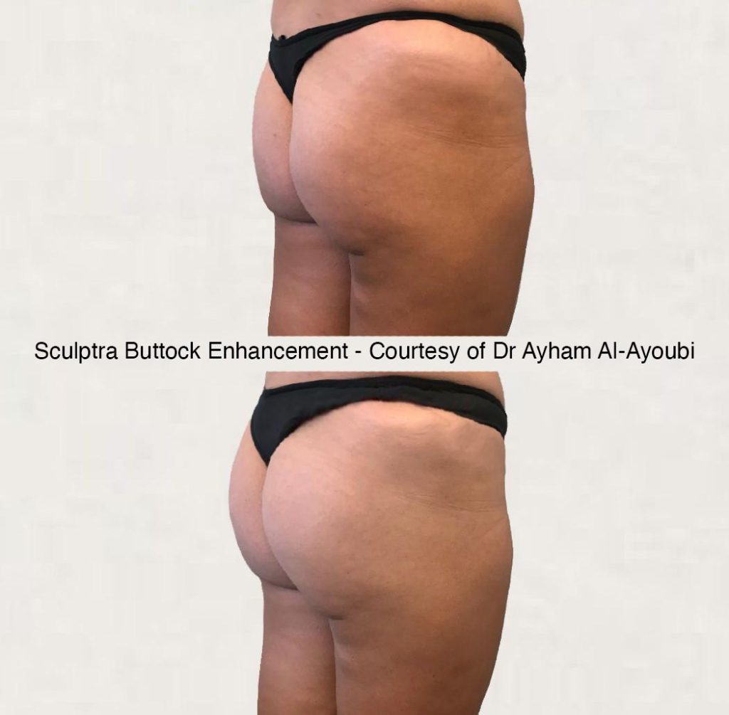 Sculptra for Buttock Enhancement by Dr Ayham Al-Ayoubi