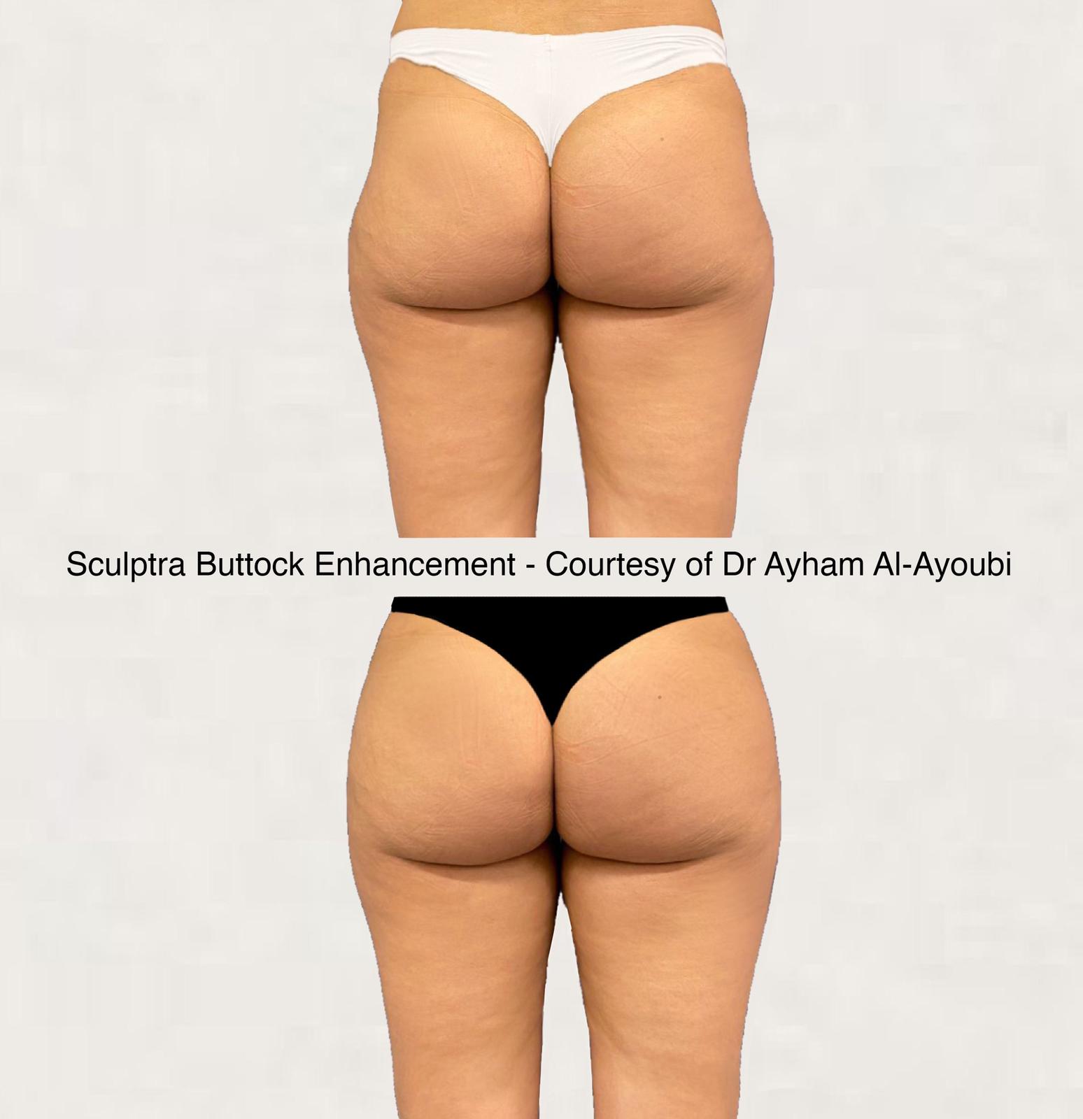 Photos – Sculptra for Buttock Enhancement