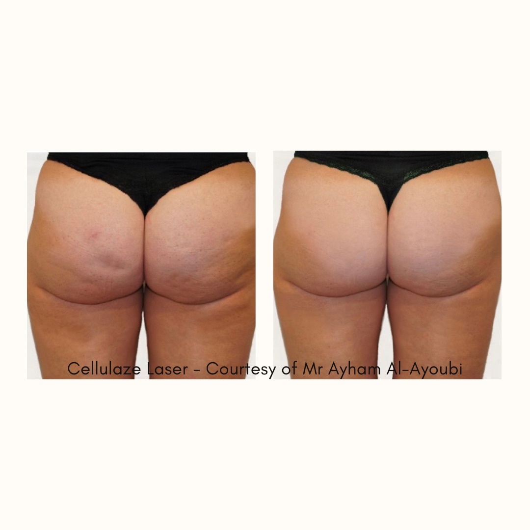 Cellulaze London, Before & After Pics (UK's Most Advance Clinic)