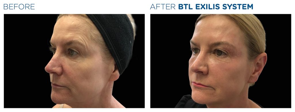 Exilis Ultra Face Treatment By Dr Ayham Al-Ayoubi