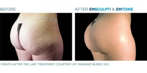 EMSculpt Neo By Dr Ayham Al-Ayoubi