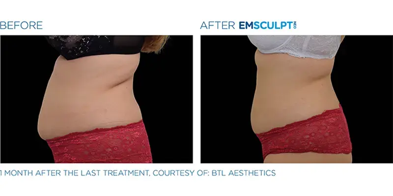 EMSculpt Neo By Dr Ayham Al-Ayoubi
