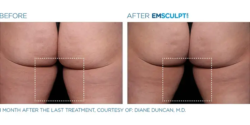 EMSculpt Neo By Dr Ayham Al-Ayoubi