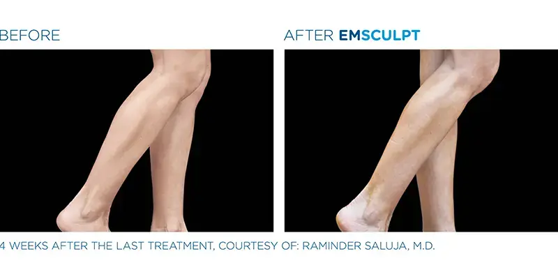 EMSculpt Neo By Dr Ayham Al-Ayoubi