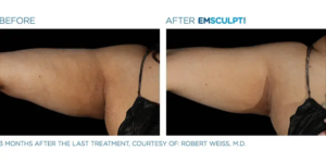 EMSculpt Neo By Dr Ayham Al-Ayoubi