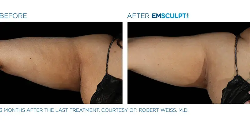 EMSculpt Neo By Dr Ayham Al-Ayoubi