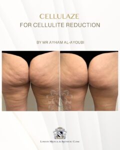 Cellulaze Laser for Permanent Cellulite Reduction by Dr Ayham Al-Ayoubi