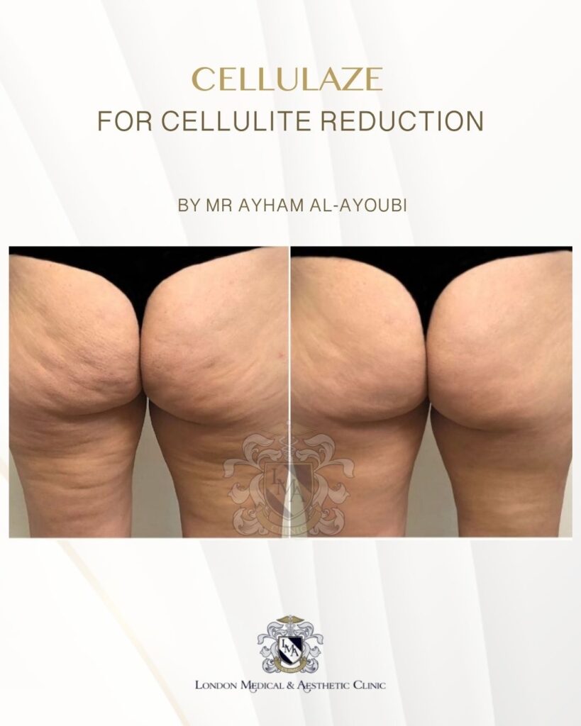 Cellulaze Laser for Permanent Cellulite Reduction by Dr Ayham Al-Ayoubi