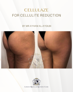 Cellulaze Laser for Permanent Cellulite Reduction by Dr Ayham Al-Ayoubi