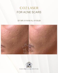 CO2 Laser Acne Scars by Dr Ayham Al-Ayoubi