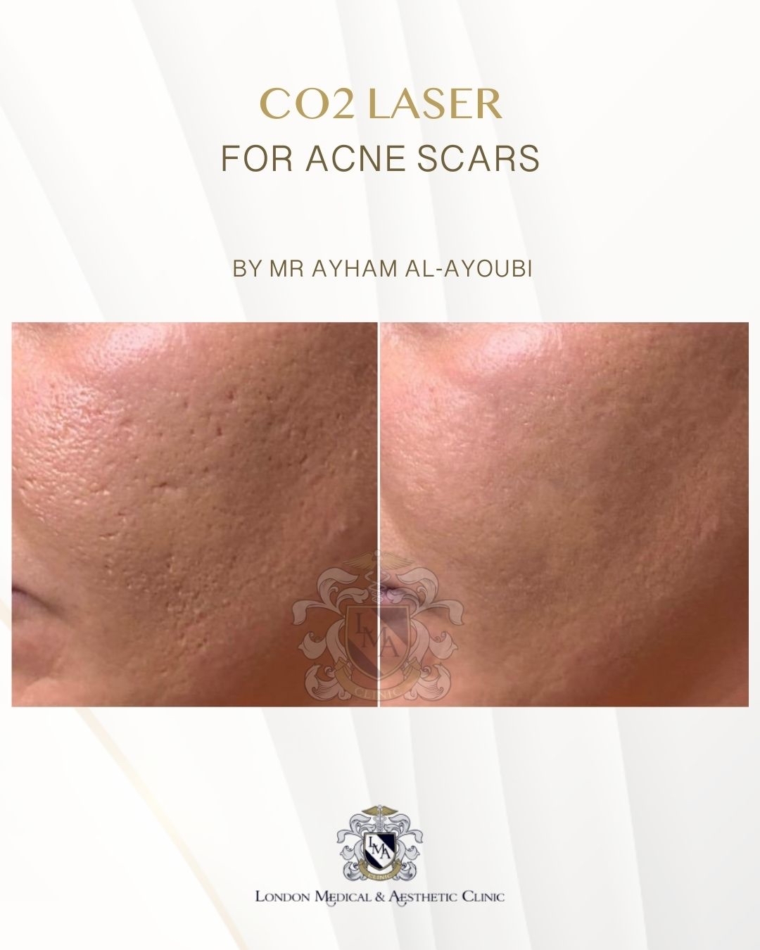 CO2 Laser Acne Scars by Dr Ayham Al-Ayoubi