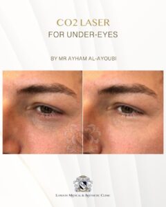 CO2 Laser Under Eyes by Dr Ayham Al-Ayoubi