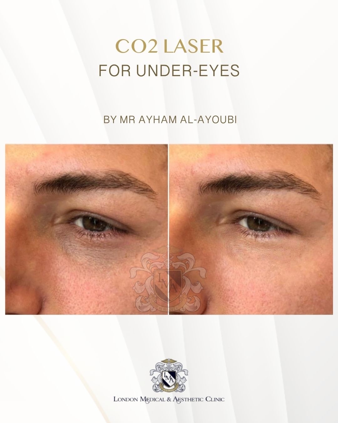 CO2 Laser Under Eyes by Dr Ayham Al-Ayoubi