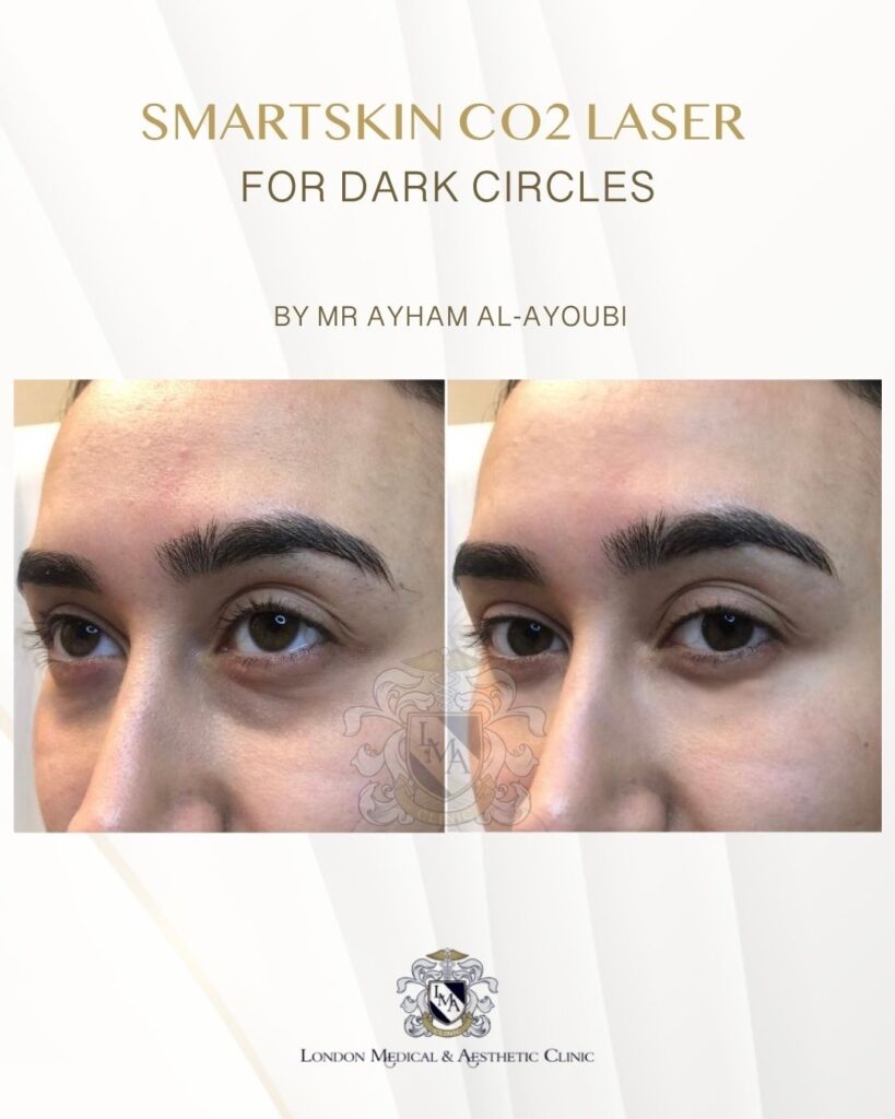 CO2 Laser Under Eyes by Dr Ayham Al-Ayoubi