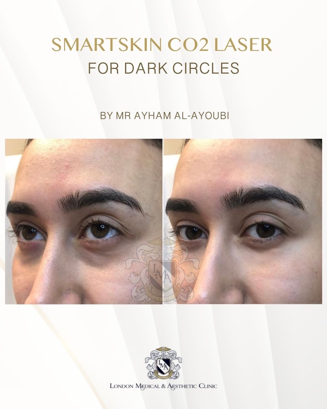 CO2 Laser Under Eyes by Dr Ayham Al-Ayoubi
