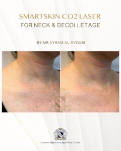 CO2 Laser Neck & Decolletage by Dr Ayham Al-Ayoubi