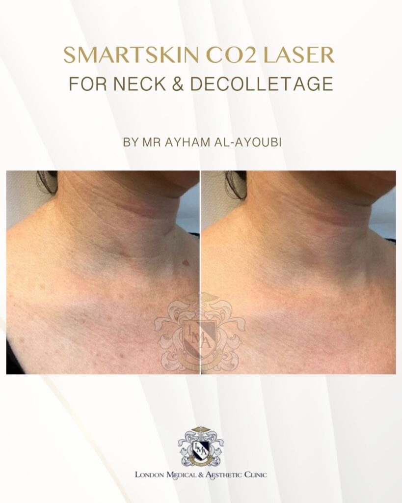 CO2 Laser Neck & Decolletage by Dr Ayham Al-Ayoubi