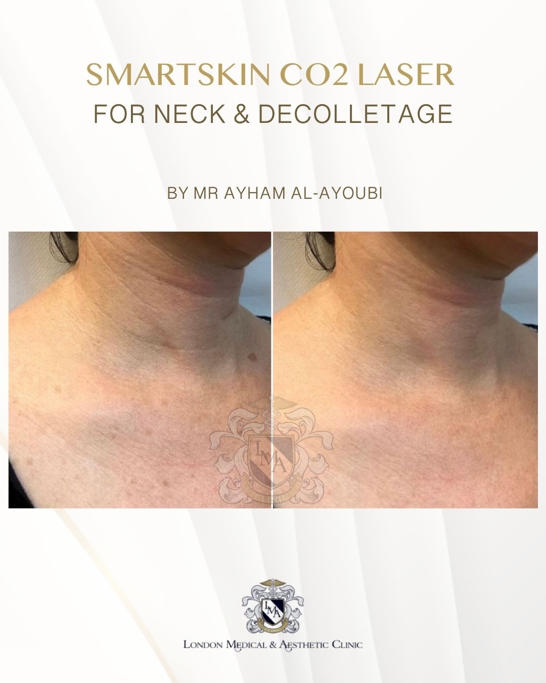 CO2 Laser Neck & Decolletage by Dr Ayham Al-Ayoubi