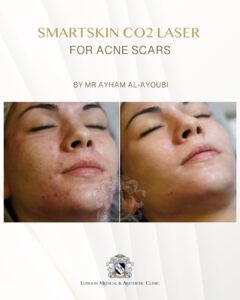 CO2 Laser Acne Scars by Dr Ayham Al-Ayoubi