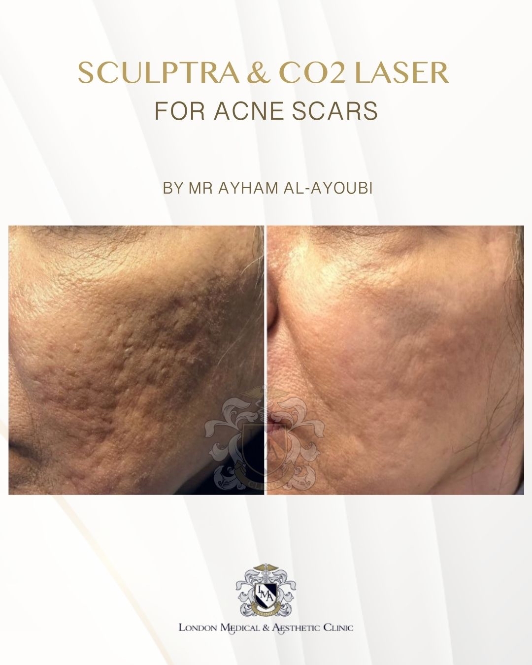 CO2 Laser Acne Scars by Dr Ayham Al-Ayoubi