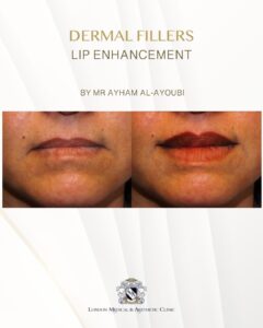 Ellanse - Courtesy of Dr Ayham Al-Ayoubi