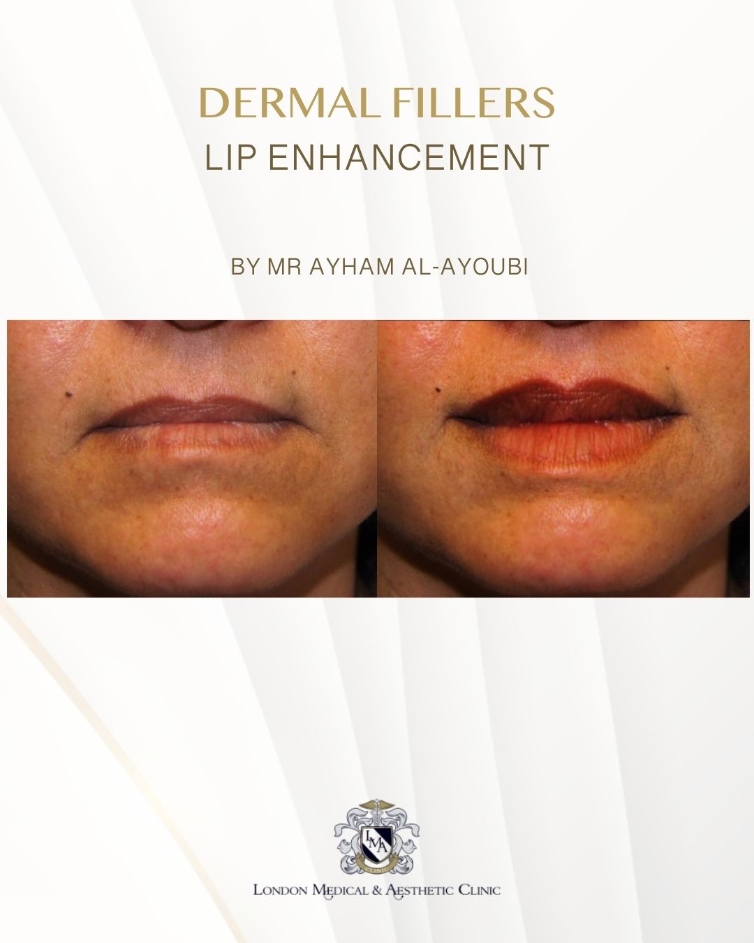 Ellanse - Courtesy of Dr Ayham Al-Ayoubi