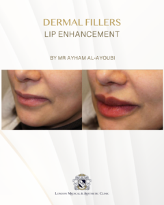 Ellanse - Courtesy of Dr Ayham Al-Ayoubi