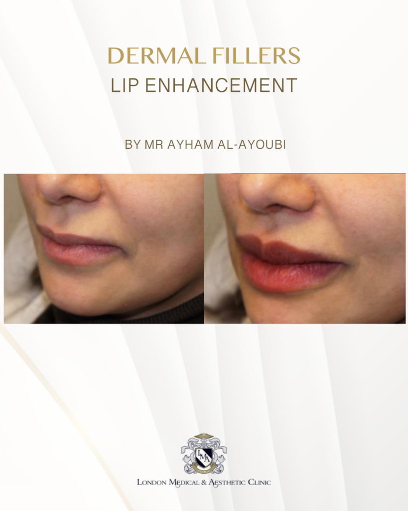 Ellanse - Courtesy of Dr Ayham Al-Ayoubi