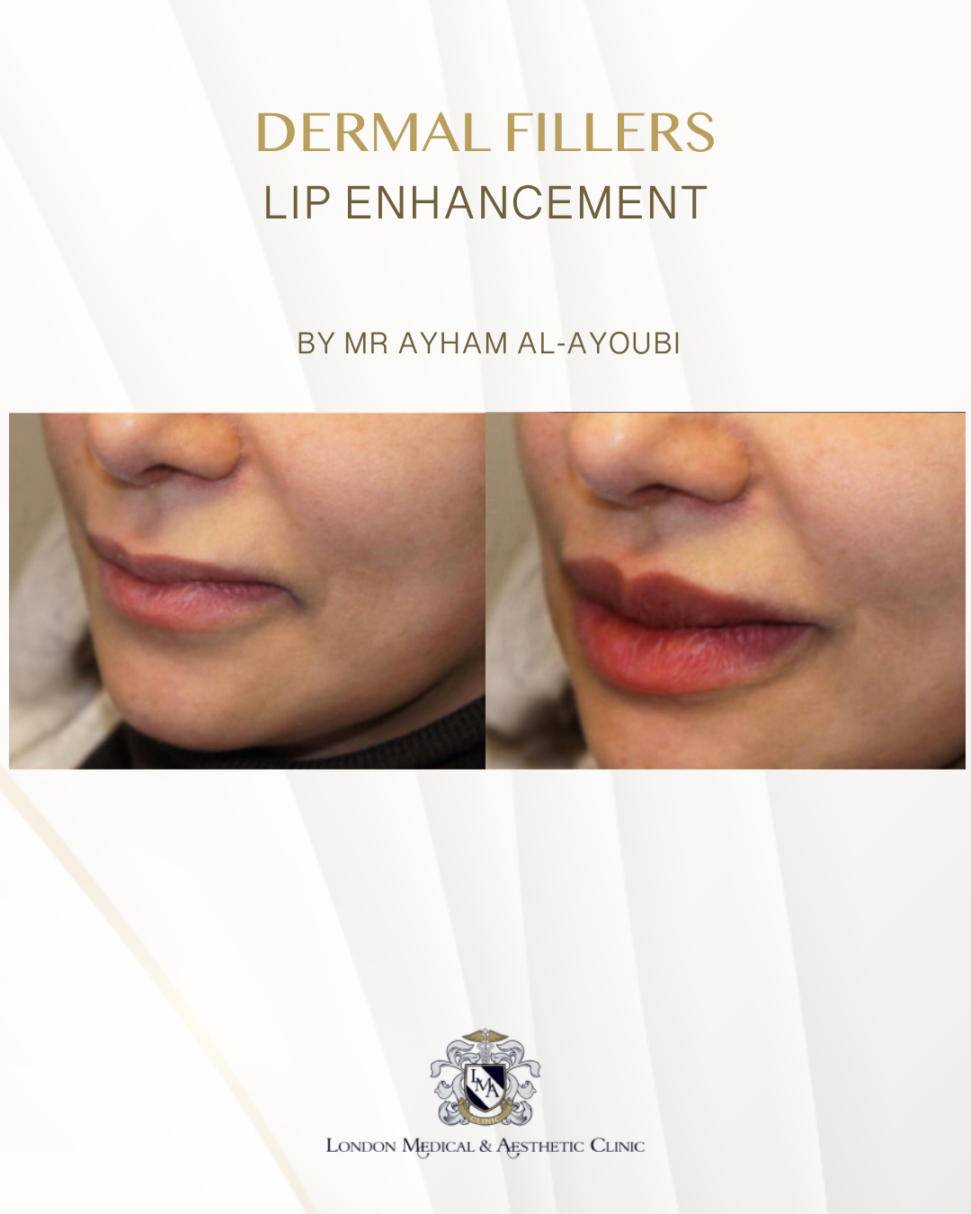 Ellanse - Courtesy of Dr Ayham Al-Ayoubi