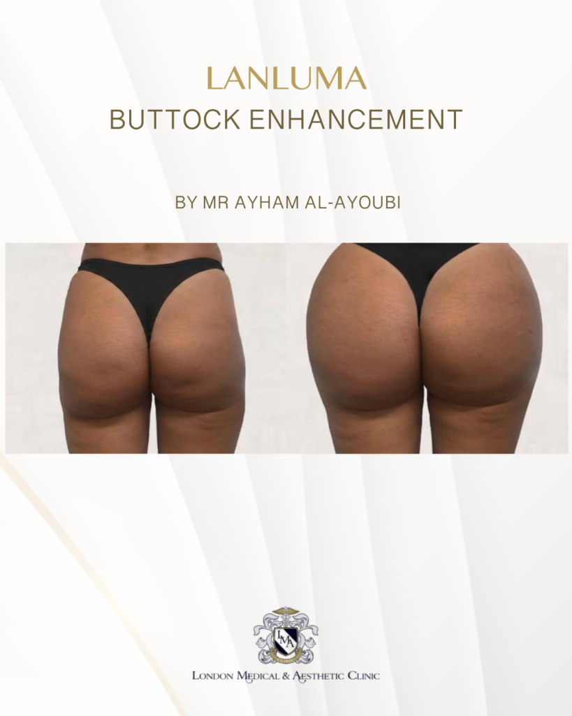Lanluma Treatment for Hip-Dips By Dr Ayham Al-Ayoubi