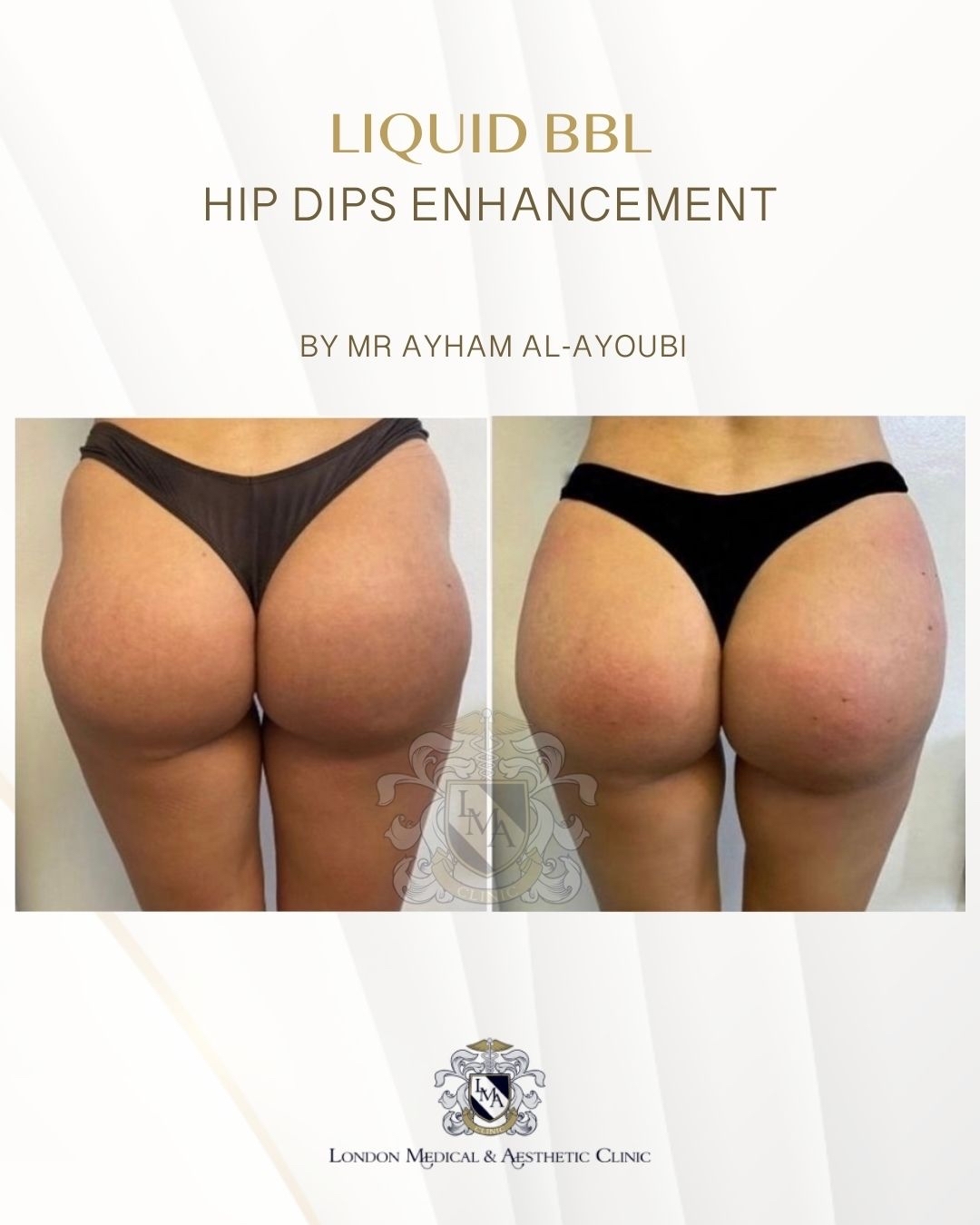 Lanluma Treatment for Hip-Dips By Dr Ayham Al-Ayoubi