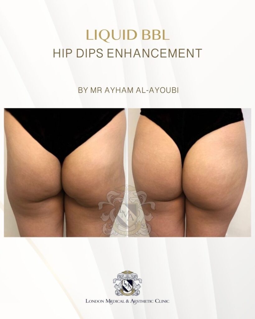 Lanluma Treatment for Hip-Dips By Dr Ayham Al-Ayoubi