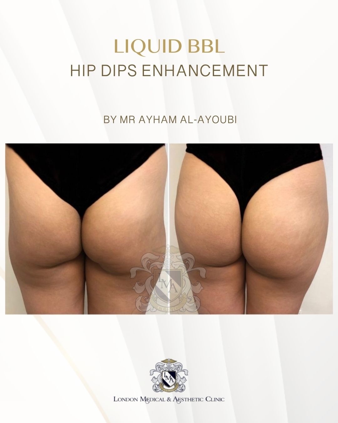 Lanluma Treatment for Hip-Dips By Dr Ayham Al-Ayoubi