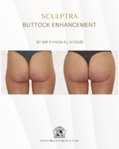 Sculptra for Buttock Enhancement by Dr Ayham Al-Ayoubi